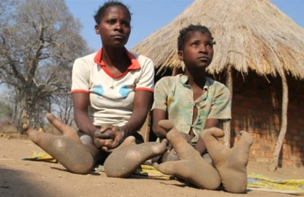 Bu insanların cəmi 2 ayaq barmağı var - FOTOLAR