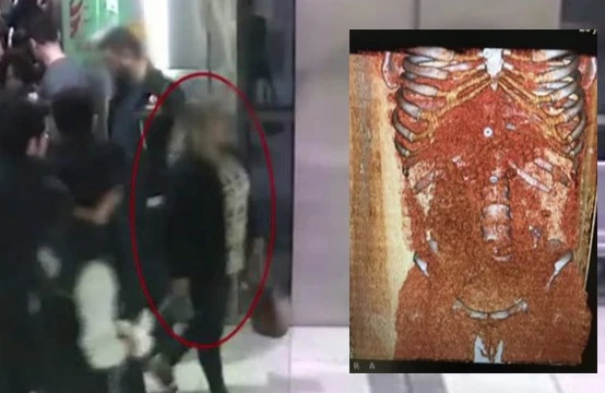 Hava limanında ŞOK olay: Qadının mədəsindən 115 ədəd prezervativ çıxdı