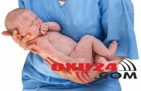 Gürcüstanda 716 nəfər qızılcaya yoluxub