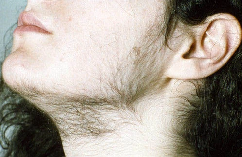 Saqqalı çıxan qadınlarda hansı xəstəlik var?