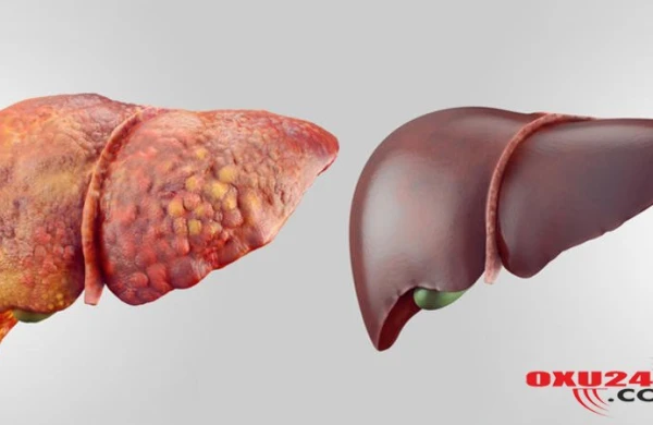 Qaraciyər çatışmazlığına səbəb olan AMİLLƏR