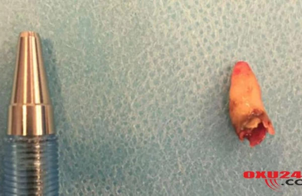 Dünyada GÖRÜNMƏMİŞ HADİSƏ - 59 yaşlı kişinin burnundan diş çıxdı