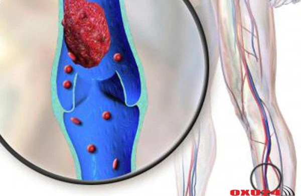 Damarda trombun olmasına işarə edən 8 əlamət