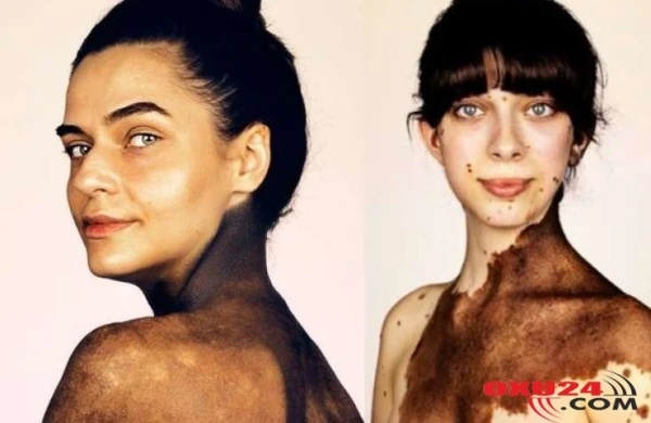 İNANILMAZ: Bu insanlar nadir dəri xəstəliyi ilə dünyaya gəliblər və... - FOTOLAR