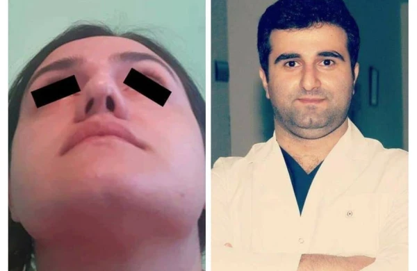 Məşhur estetik cərrah gənc qızın burnunu pis hala saldı- FOTO