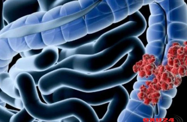 Bağırsaq xərçəngindən qoruyan qidalar – SİYAHI