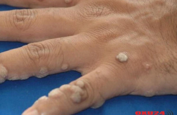 Ziyilləri necə apara bilərik? - 2 qaşıq sodanı.