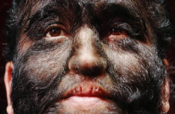 Tüklənmə xəstəliyinin təhlükəsi varmı?-Həkimdən vacib açıqlama