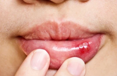 Ağızda  çıxan yaralar bu xəstəliklərin əlamətidir