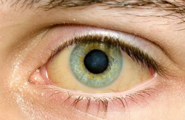 Gözlərinə bax, xəstəliyini tap - Təhlükəli dəyişikliklər