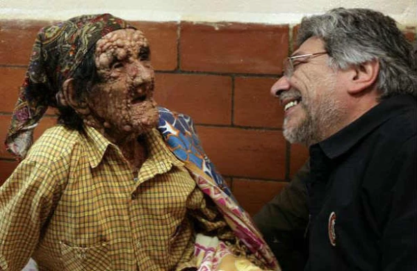 Bədən çürüyür,burun düşür,barmaqlar əyilir - Azərbaycanda  bu  xəstələr  xüsusi  ərazidə  yaşayır