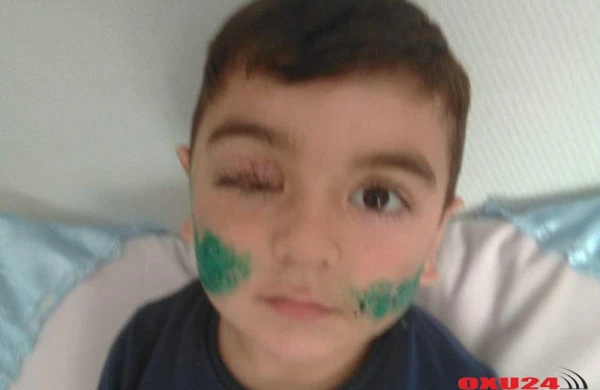 Üzünü it parçalayan uşağın SON DURUMU - FOTO