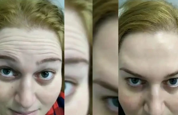 Bakıda kosmetoloqdan inanılmaz nəticə!Qırışları 5 dəqiqədə yox etdi