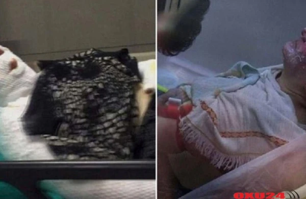 Ərinin qulaq tüklərini təmizləmək istədi - İKİSİ DƏ YANDI - FOTO