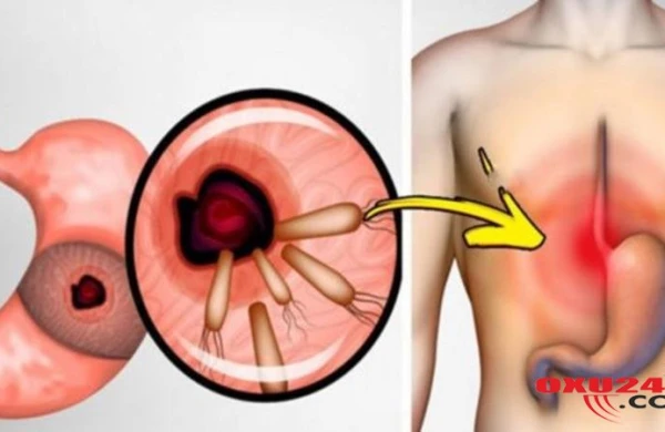 Mədə xərçəngindən qurtulmağın yolu - ŞƏRTLƏR