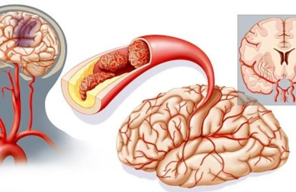 İnsultun 15 əlaməti - Həyatınızı belə xilas edin