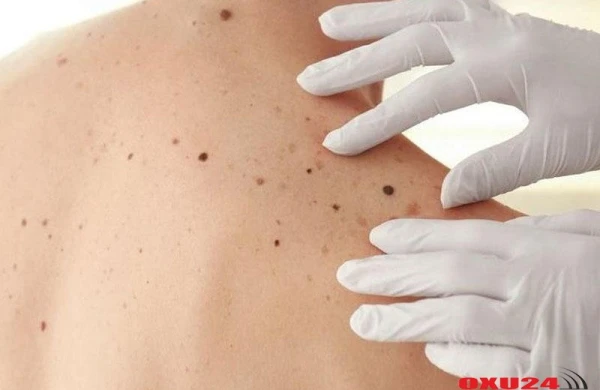 Bədəndə çox sayda xal olması nəyin əlamətidir - DİQQƏT