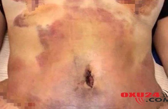 Əməliyyat olunan qadının qarnı çürüyüb – Foto