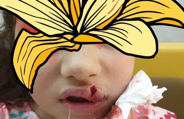 Bakıda dəhşətli hadisə:It insanların gözü qarşısında uşağın üzünü parçaladı