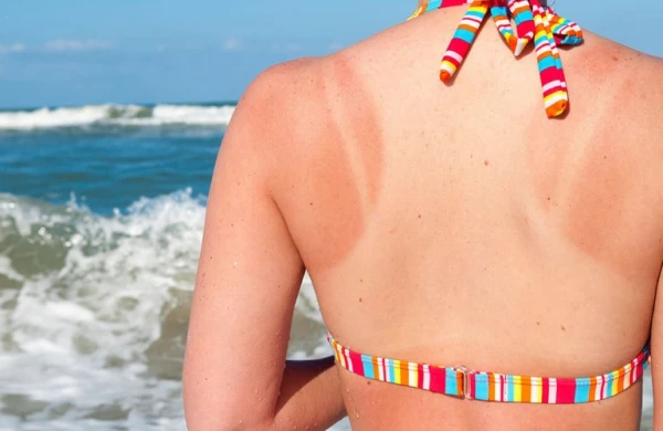 Günəş yanıqlarından qorunmağın effektiv üsulları – YAY FƏSLİNİN ƏN BÖYÜK DƏRDİ