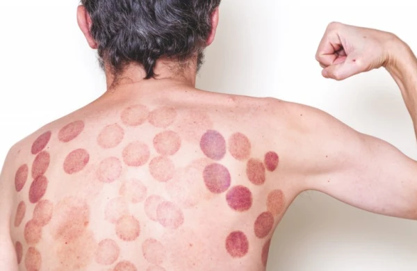 Bu xəstəliklərdə banka qoymaq qadağandır