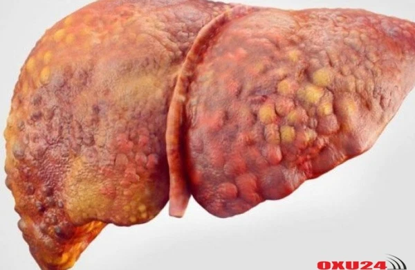 Sirrozu təkcə hepatit yaratmır, başqa səbəblər də çoxdur – Müayinə barədə həkim məsləhəti