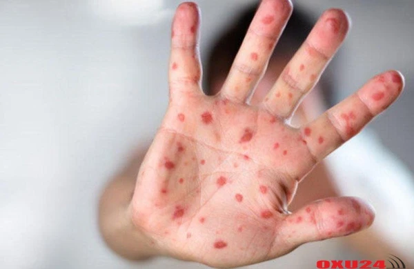 Bu il qızılcaya yoluxanların sayı rekord həddə çatıb - 1109 nəfər