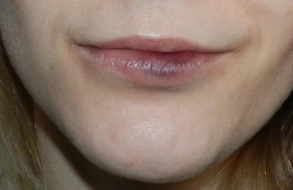 Göyərmiş dodaqlar hansı təhlükədən xəbər verir?- DƏHŞƏTLİ  XƏSTƏLİYİN ƏLAMƏTİ