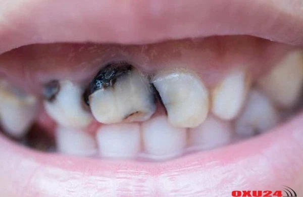 Bu qidalar dişləri MƏHV EDİR - Məşhur stomatoloqdan VACİB XƏBƏRDARLIQ