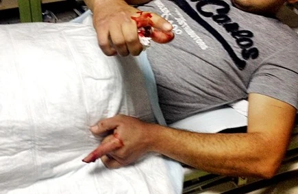 Azərbaycanda dəhşətli hadisə: Kişinin gözü çıxdı,barmaqları qopub düşdü