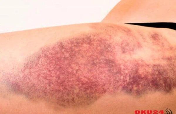 Hematoma və göyərmələrə qarşı effektiv vasitə - 1 günə aparır