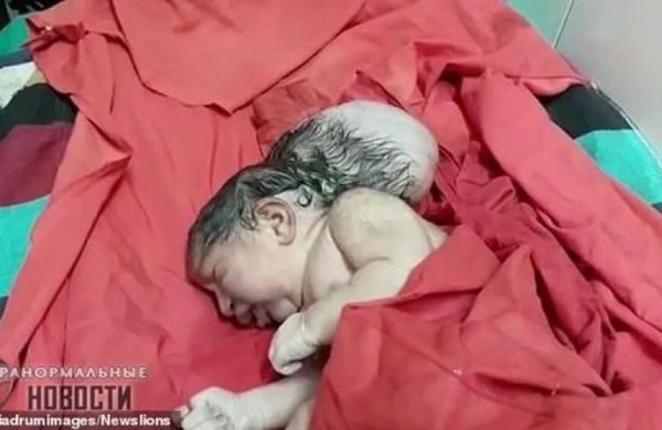 Üçbaşlı uşaq doğuldu - FOTOLAR