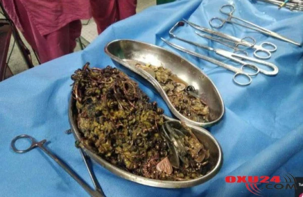 Görün qızın mədəsindən nələr çıxdı- Gözlərinizə inanmayacaqsınız !