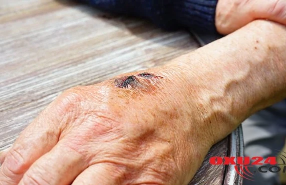 Qarayaradan ilk ölüm: bu xəstəlik nədir və necə yaranır?