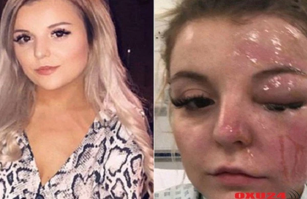 Yumurta qaynatmaq istədi gözünü itirdi