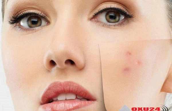 İltihablı sızanaqlardan qurtulmaq üçün maska