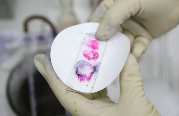 SON DƏQİQƏ! Ermənistanda öldürücü təhlükəli xəstəlik yayıldı