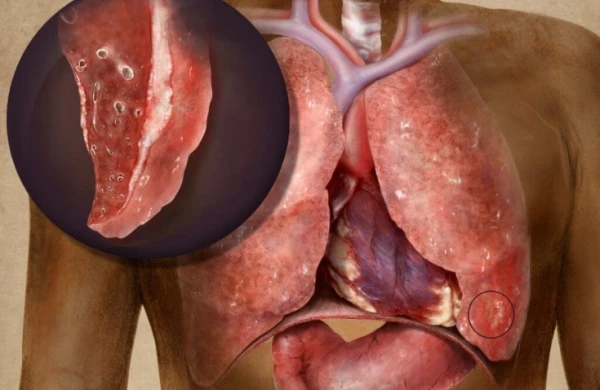 Vərəmin 6 əlaməti – Gecikməyin!