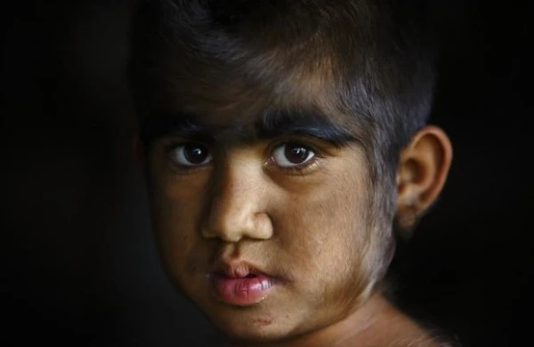 Uşaqlar arasında nadir xəstəlik yayıldı - "Qulyabanı sindromu"