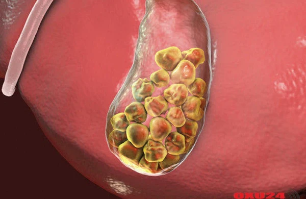 Yağdan imtina edən insanlarda öd daşı daha da çoxalıb, böyüyür – Rusiyanın tanınmış hepatoloqu