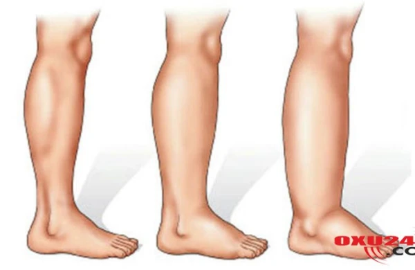 Ayaqların şişməsi hansı xəstəliyin əlamətidir? - Həkimdən XƏBƏRDARLIQ