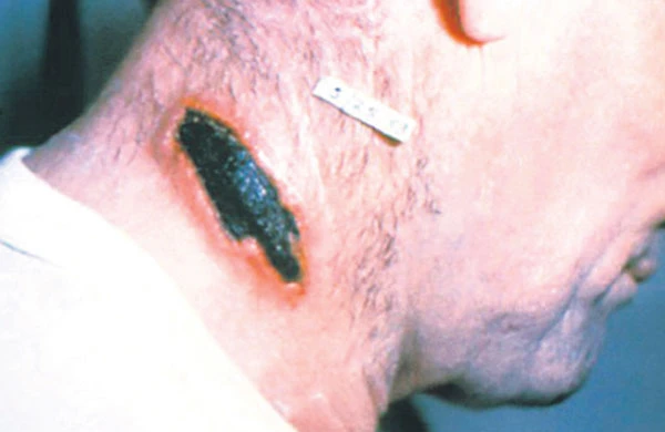 TƏCİLİ: Azərbaycanda qarayara xəstəliyi yayıldı