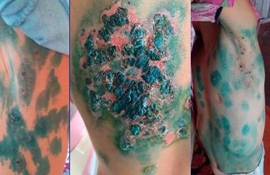 Nazirlikdən Balakəndə yayılan naməlum xəstəliklə bağlı - Açıqlama