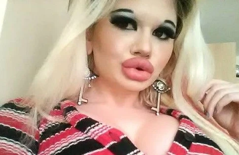 Tələbə dünyanın ən iri dodaqlı qızı olmaq istəyir - FOTO
