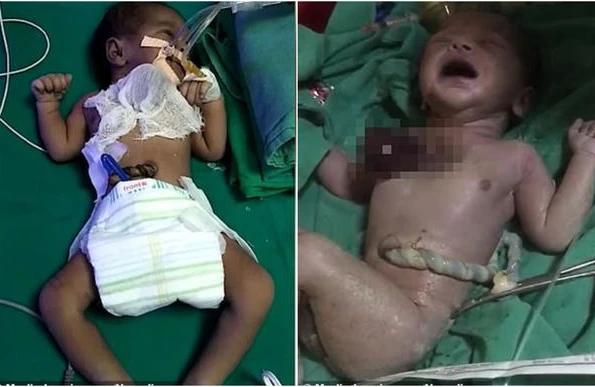 Ürəyi bədənin xaricində olan uşaq doğulub