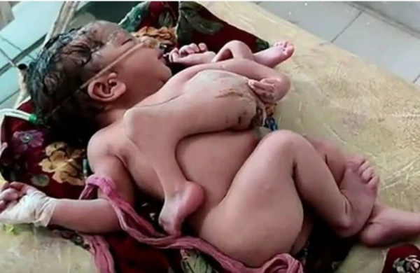 Dörd ayaqlı, üç əlli körpə doğuldu – FOTO