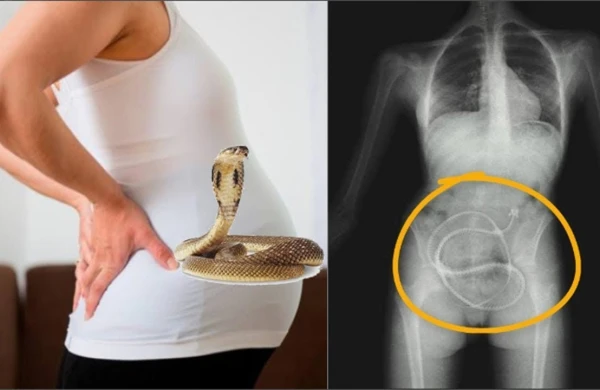 Həkimlər şokda: Hamilə qadının bətnindən uşaq əvəzinə ilan çıxdı