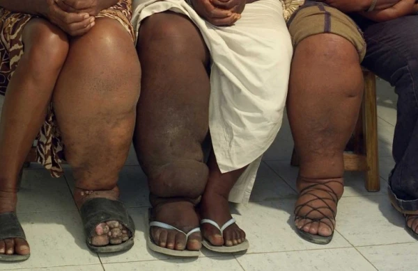 İnsanda olan dəhşətli fil xəstəliyi nədən yaranır?