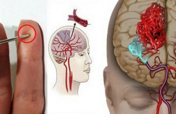 İnsult zamanı xəstənin barmaqlarını deşin - İLK YARDIM