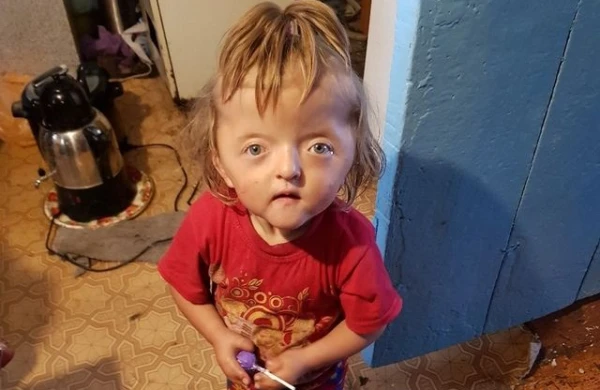 Девочке с деформированным черепом из Башкирии не сделают операцию на голову